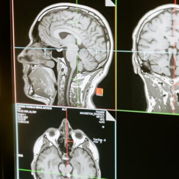 Fisioterapia tem sido aliada no tratamento de sequelas pós-AVC