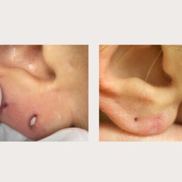 Lobuloplastia sem cirurgia: entenda como funciona o procedimento que não requer anestesia e nem sutura