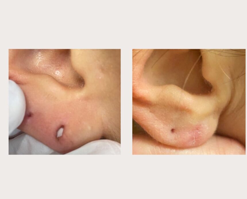Lobuloplastia sem cirurgia: entenda como funciona o procedimento que não requer anestesia e nem sutura