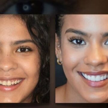 A revolução da estética odontológica: facetas transformam sorrisos, rostos e autoestima