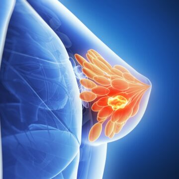 7 fatos sobre o câncer de mama que toda mulher precisa saber